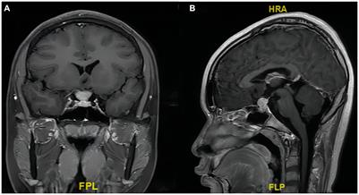 Primary pituitary stalk mucosa-associated lymphoid tissue lymphoma: a case report and literature review